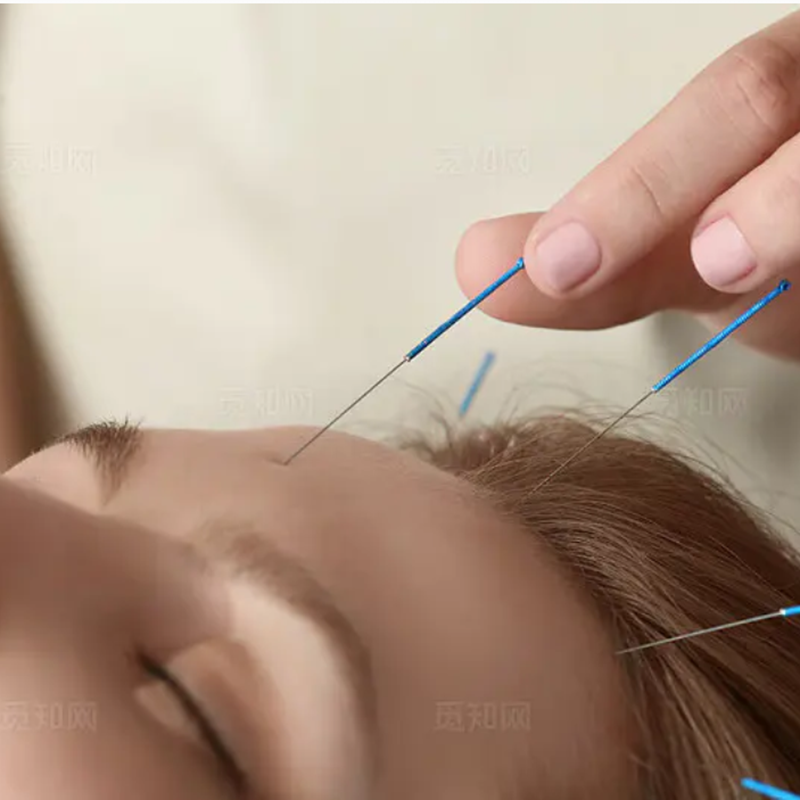 Acupuncture
